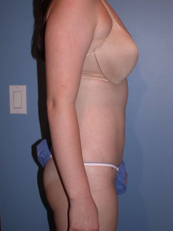 Liposuction Gallery Before & After Gallery - Patient 4752207 - Image 10