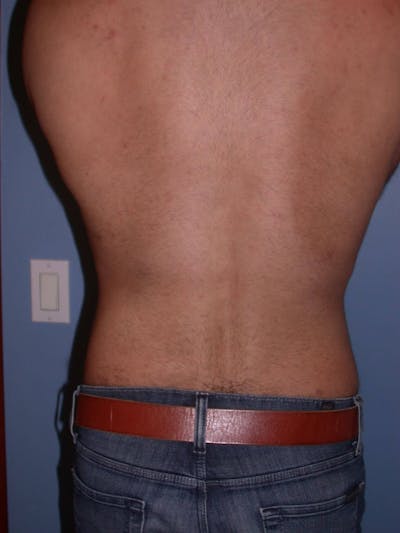 Liposuction Gallery Before & After Gallery - Patient 4752211 - Image 8