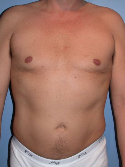 Liposuction Gallery Before & After Gallery - Patient 4752215 - Image 2