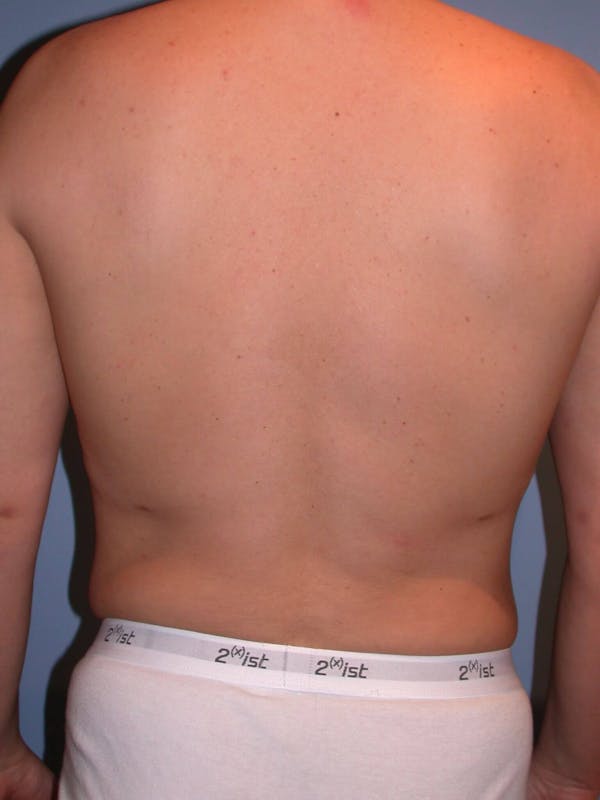 Liposuction Before & After Gallery - Patient 4752215 - Image 8