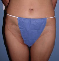 Thigh Lift Before & After Gallery - Patient 4752226 - Image 1
