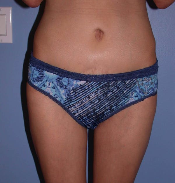 Thigh Lift