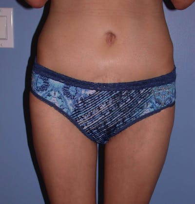 Thigh Lift Before & After Gallery - Patient 4752226 - Image 2