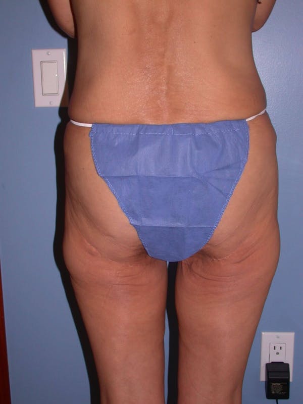 Thigh Lift Gallery Before & After Gallery - Patient 4752226 - Image 3