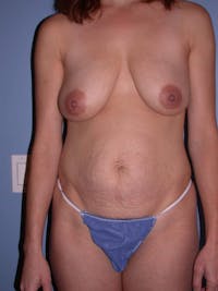 Mommy Makeover Gallery - Patient 4752230 - Image 1