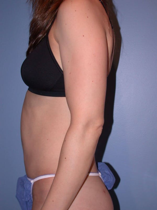 Mommy Makeover Before & After Gallery - Patient 4752231 - Image 4