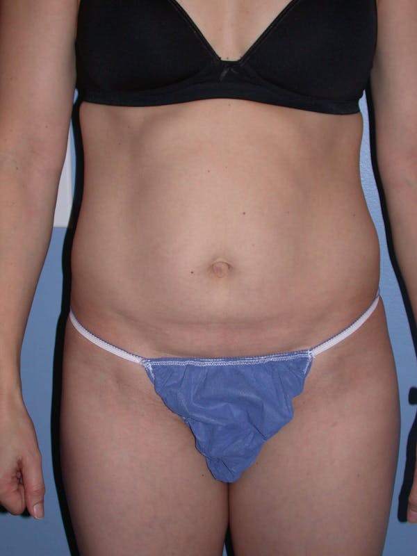 Mommy Makeover Before & After Gallery - Patient 4752231 - Image 5