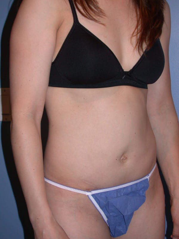 Mommy Makeover Before & After Gallery - Patient 4752231 - Image 8