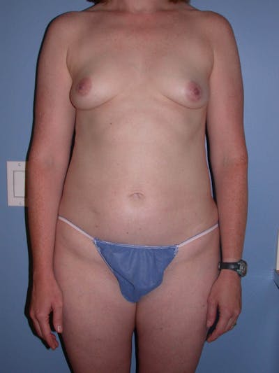 Mommy Makeover Gallery Before & After Gallery - Patient 4752259 - Image 1