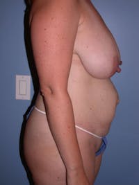 Mommy Makeover Before & After Gallery - Patient 4752260 - Image 1