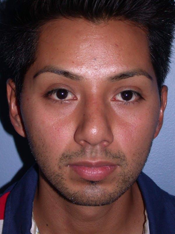  Before and After Botox Treatment in San Francisco