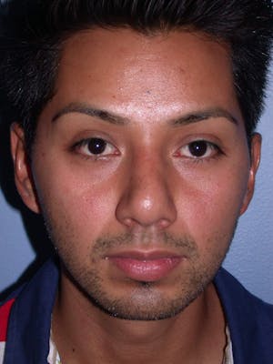 Before and After Botox Treatment in San Francisco