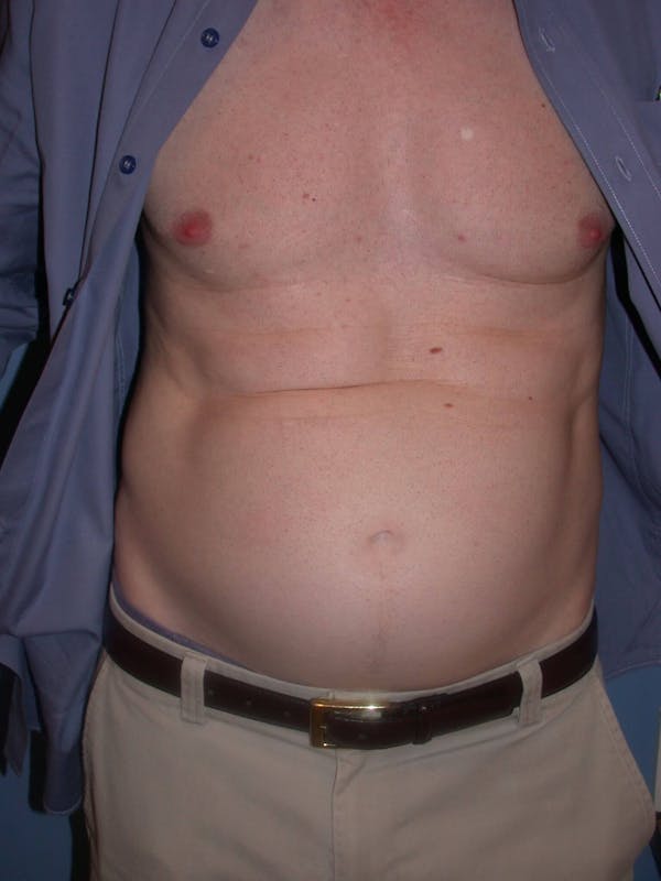 Before Tummy Tuck