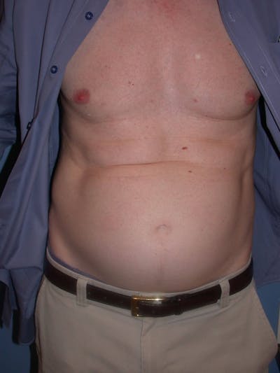 Tummy Tuck Gallery Before & After Gallery - Patient 4756854 - Image 1