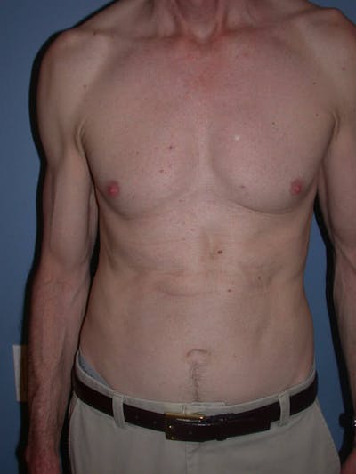 Tummy Tuck Gallery Before & After Gallery - Patient 4756854 - Image 2