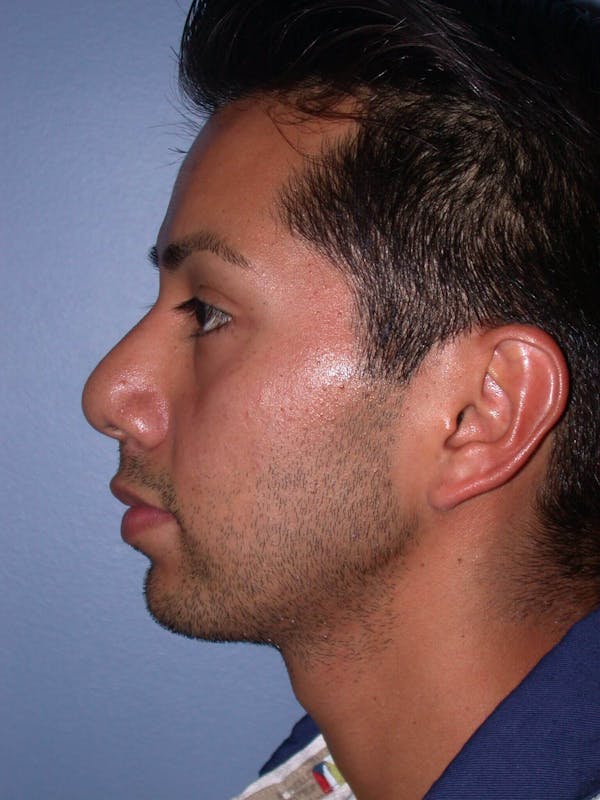 BOTOX Gallery Before & After Gallery - Patient 4756855 - Image 3