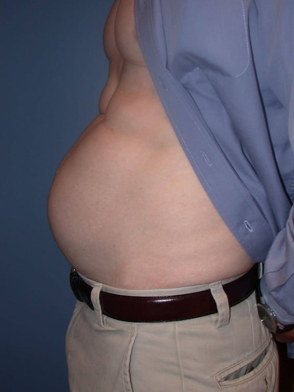 Tummy Tuck Gallery Before & After Gallery - Patient 4756854 - Image 3