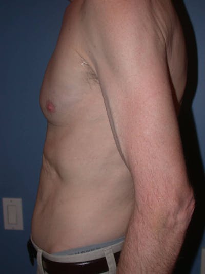 Tummy Tuck Gallery Before & After Gallery - Patient 4756854 - Image 4