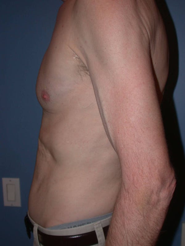 Tummy Tuck Gallery Before & After Gallery - Patient 4756854 - Image 4