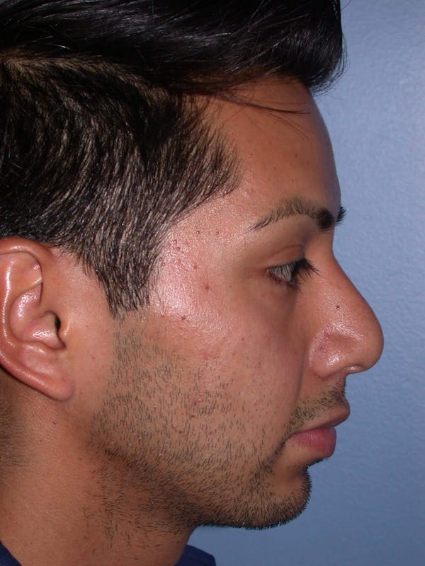 BOTOX Gallery Before & After Gallery - Patient 4756855 - Image 5