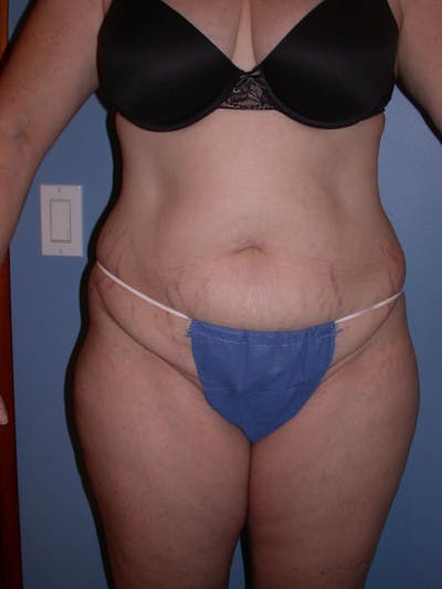 Tummy Tuck Gallery Before & After Gallery - Patient 4756858 - Image 1