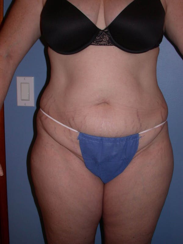 Tummy Tuck Gallery - Patient 4756858 - Image 1