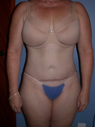 Tummy Tuck Gallery Before & After Gallery - Patient 4756858 - Image 2