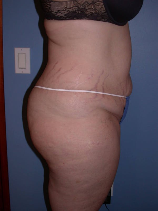 Tummy Tuck Gallery Before & After Gallery - Patient 4756858 - Image 3
