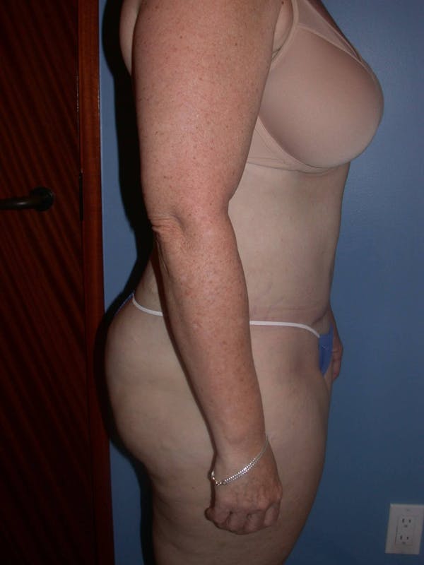 Tummy Tuck Gallery Before & After Gallery - Patient 4756858 - Image 4