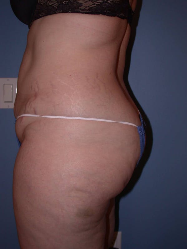 Tummy Tuck Gallery Before & After Gallery - Patient 4756858 - Image 5