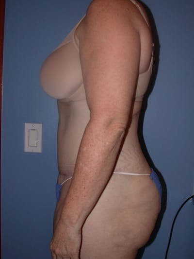 Tummy Tuck Gallery Before & After Gallery - Patient 4756858 - Image 6