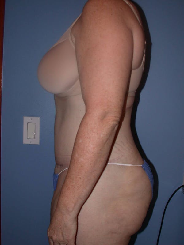 Tummy Tuck Gallery Before & After Gallery - Patient 4756858 - Image 6