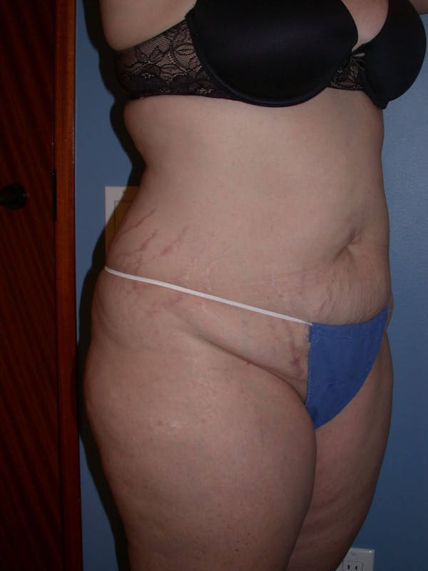 Tummy Tuck Gallery Before & After Gallery - Patient 4756858 - Image 7