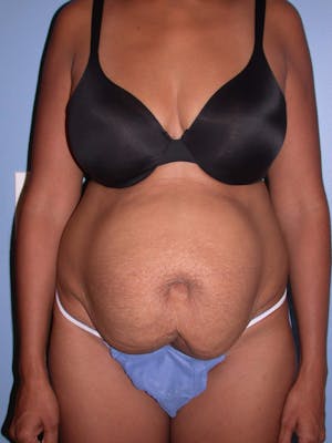 Before & After a Tummy Tuck in San Francisco