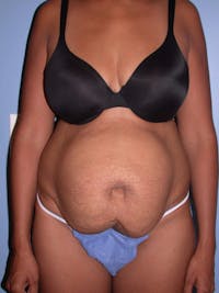 Tummy Tuck Gallery Before & After Gallery - Patient 4756862 - Image 1