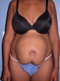 Tummy Tuck Before & After Gallery - Patient 4756862 - Image 1