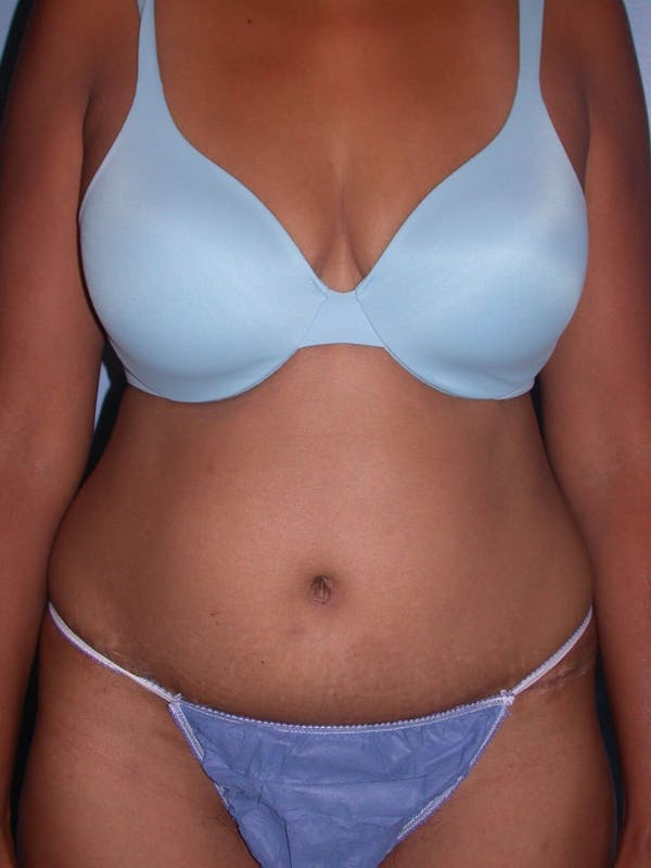 Before & After a Tummy Tuck in San Francisco