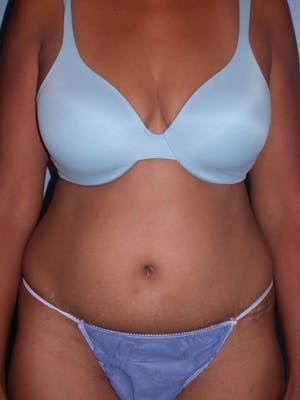 Before & After a Tummy Tuck in San Francisco