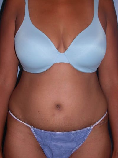 Tummy Tuck Gallery - Patient 4756862 - Image 2