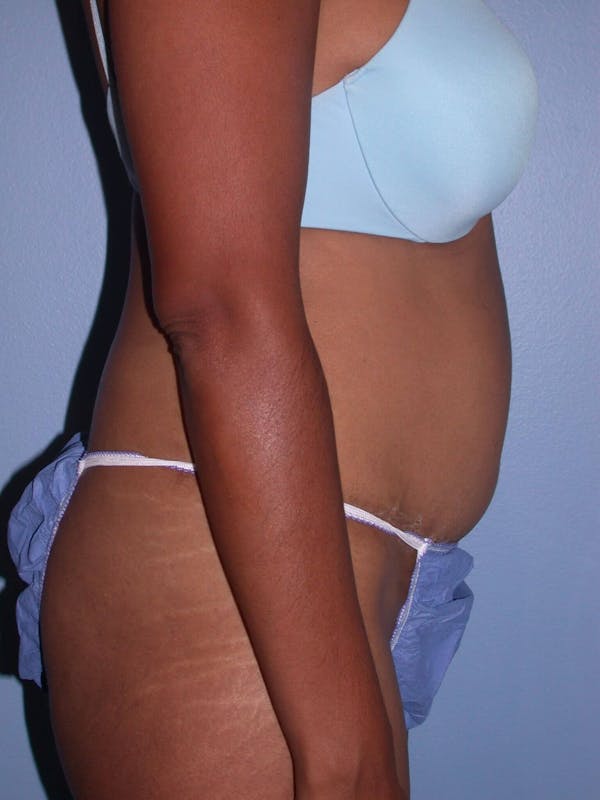 Tummy Tuck Gallery Before & After Gallery - Patient 4756862 - Image 4