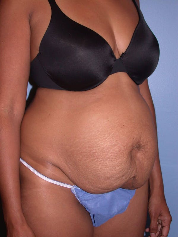 Tummy Tuck Gallery Before & After Gallery - Patient 4756862 - Image 7