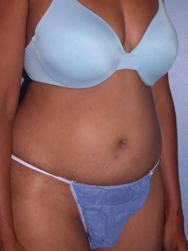 Tummy Tuck Gallery Before & After Gallery - Patient 4756862 - Image 8