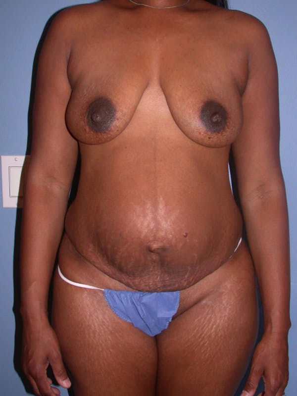 Tummy Tuck Before & After Gallery - Patient 4756870 - Image 1