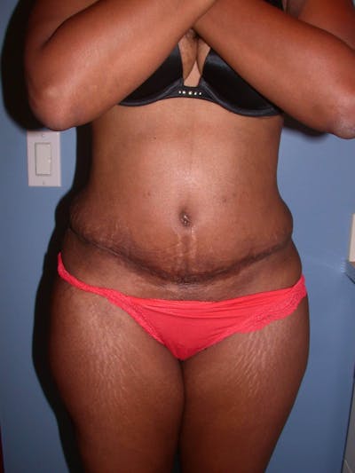 Tummy Tuck Gallery Before & After Gallery - Patient 4756870 - Image 2