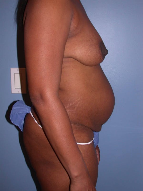 Tummy Tuck Gallery Before & After Gallery - Patient 4756870 - Image 3