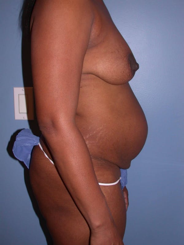 Before & After a Tummy Tuck in San Francisco