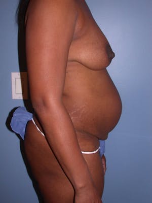 Before & After a Tummy Tuck in San Francisco