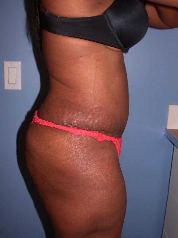 Before & After a Tummy Tuck in San Francisco