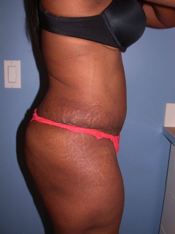 Tummy Tuck Before & After Gallery - Patient 4756870 - Image 4