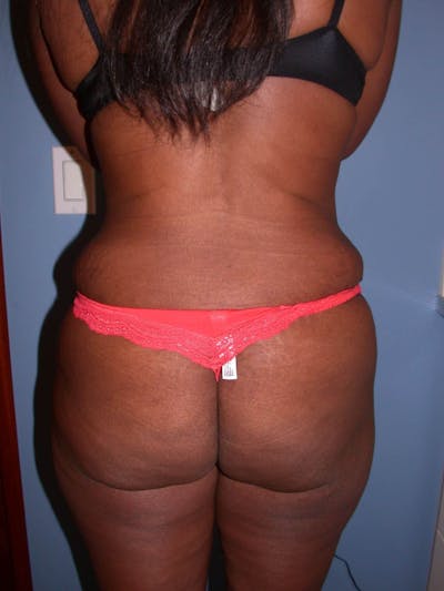 Tummy Tuck Before & After Gallery - Patient 4756870 - Image 6